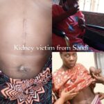 Shocking of dubiously stolen, lost kidney; How doctors lied, fabricated, forged medical reports of a Saudi Arabia Ugandan Kadama.